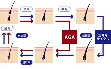 AGAとヘアサイクルの関係を示す図